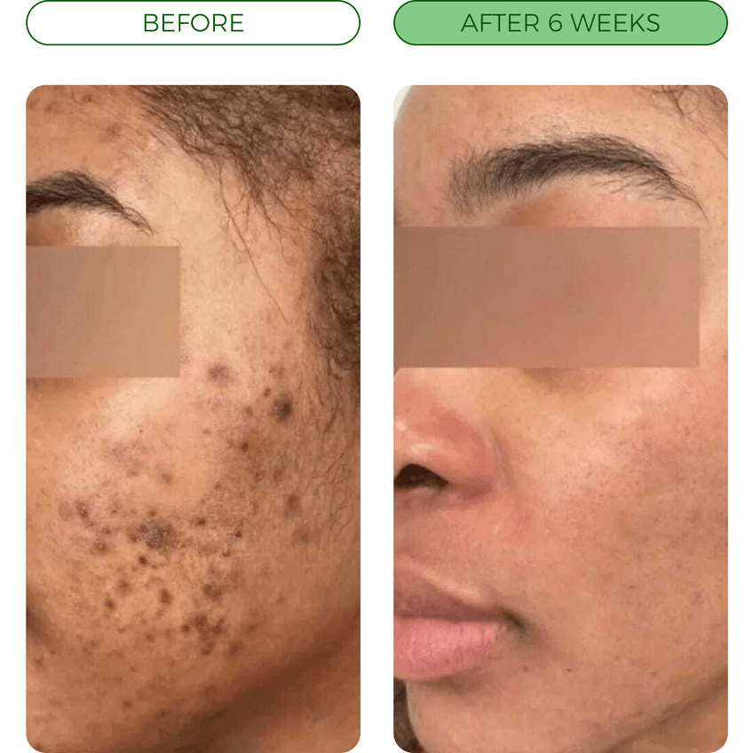 💛Turmeric Acne Killing Bar✅ - Deep Pore Cleansing & Repair Ritual