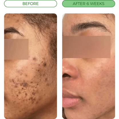 💛Turmeric Acne Killing Bar✅ - Deep Pore Cleansing & Repair Ritual