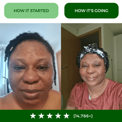 💛Turmeric Acne Killing Bar✅ - Deep Pore Cleansing & Repair Ritual