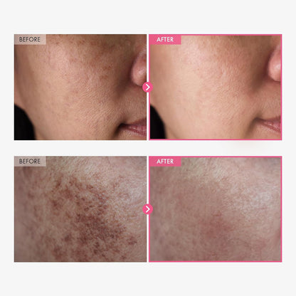 up✨Loftpromo® High-Potency Brightening & Dark Spot Corrector Cream