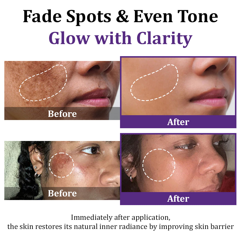 💜✅Loftpromo® EPIGLOW MelanEX: The Ultimate Dark Spot Eraser